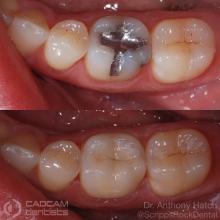 cadcam before & after